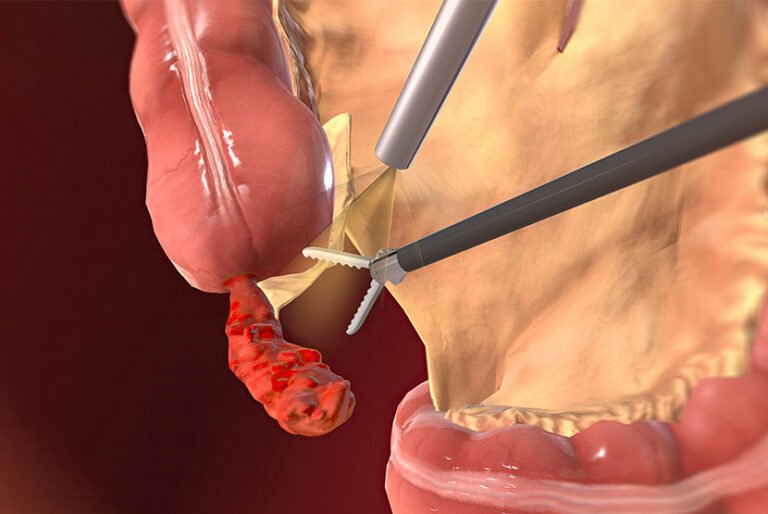 Best Appendix Doctor in Ahmedabad | Dr. Varun Bajaj