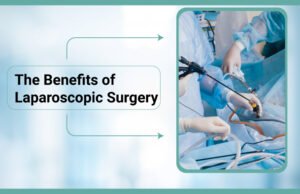 Benefits of Laparoscopic Surgery