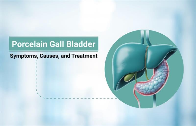 Porcelain Gall Bladder: Symptoms, Causes, and Treatment