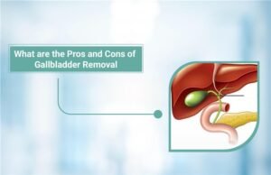 Pros and Cons of Gallbladder Removal