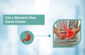 Can a Stomach Ulcer Cause Cancer
