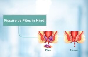 Fissure vs Piles in Hindi