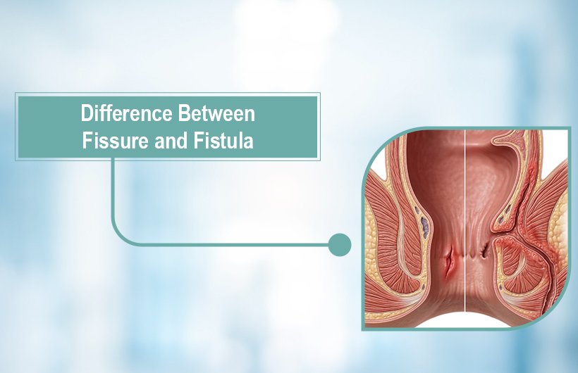 Difference Between Fissure and Fistula