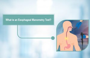 Esophageal Manometry Test