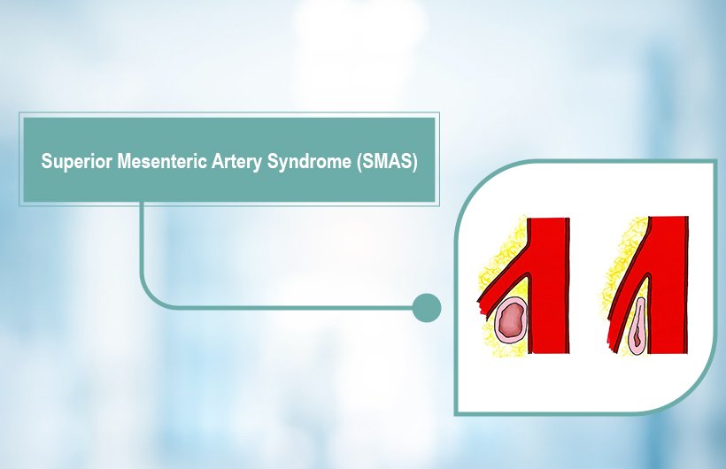 Superior Mesenteric Artery Syndrome (SMAS): Symptoms, Causes & Treatment Guide 2026