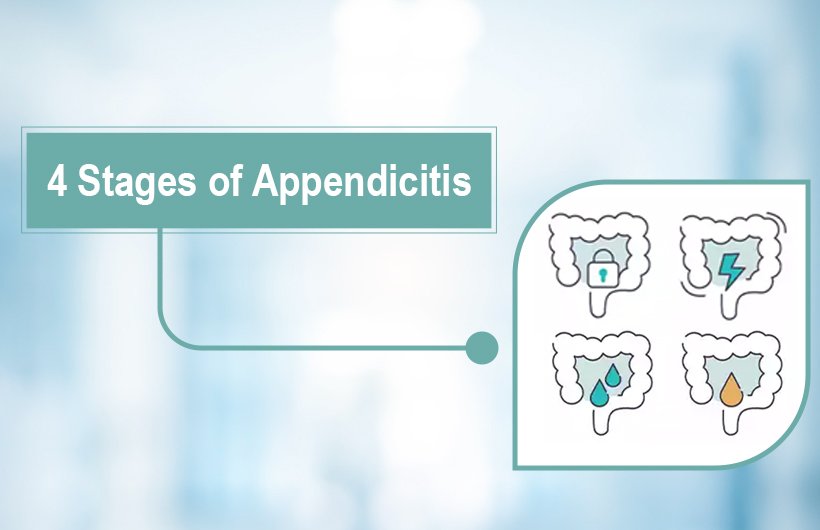 4 Stages of Appendicitis: Symptoms, Pain Progression & Treatment