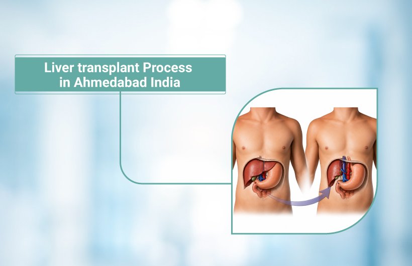 Liver Transplant Process in Ahmedabad1